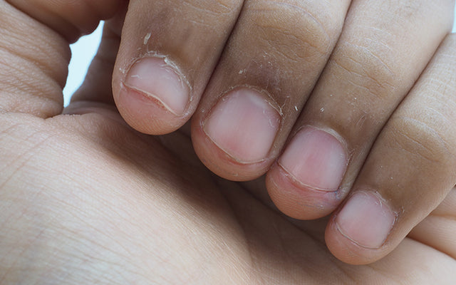12 redenen waarom uw vingertoppen kunnen peelen