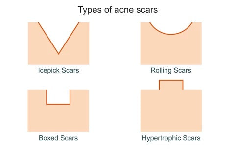Soorten acne littekens
