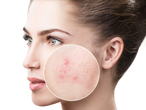 Acne of acne vulgaris