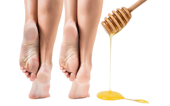 voeten met een droge huid voor en na de honingbehandeling
