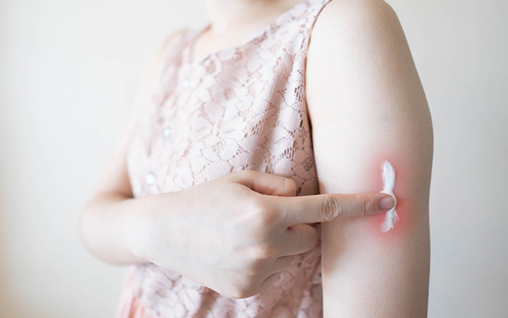 jonge vrouw die steroïde crème aanbrengt op roodheid huiduitslag voor de behandeling van dermatitis