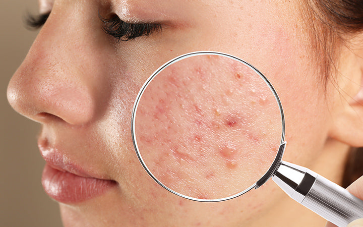 Meisje met acne op gezicht bezoekende dermatoloog