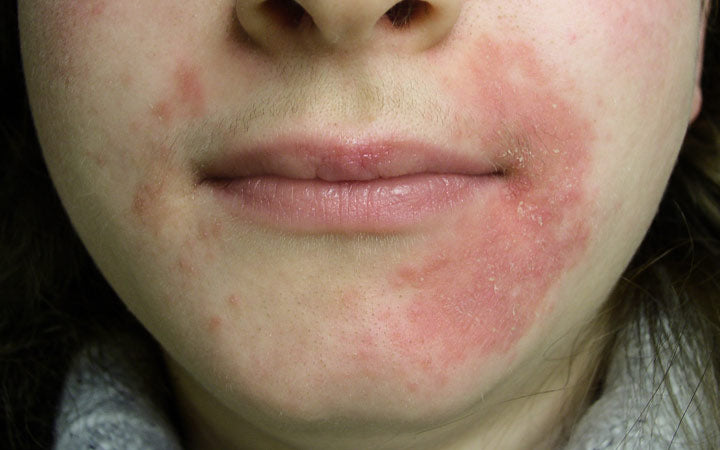 Periorale dermatitis op het gezicht