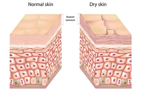 Symptomen van een droge huid
