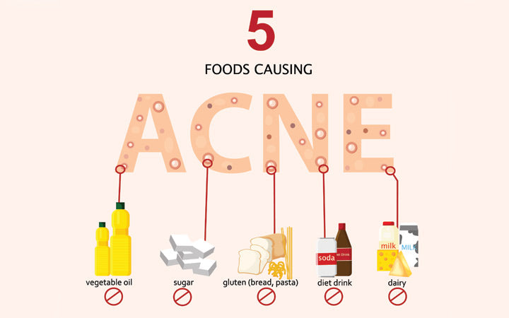 Acne dieet: 9 voedingsmiddelen die puistjes veroorzaken (plus voedingsmiddelen die ze opruimen)