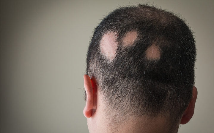 Alopecia Areata - Hier is alles wat u erover moet weten