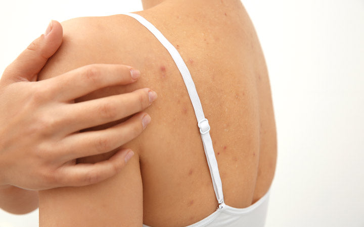 Rug acne: 6 oorzaken, 11 behandelingen &16 preventie tips