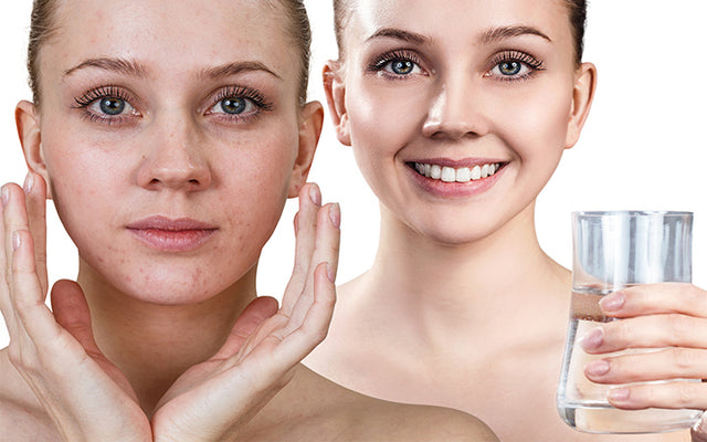 De beste anti-acne drankjes om een stralende huid te bereiken