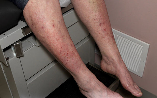 Dermatitis Herpetiformis en glutenintolerantie: wat is het verband?