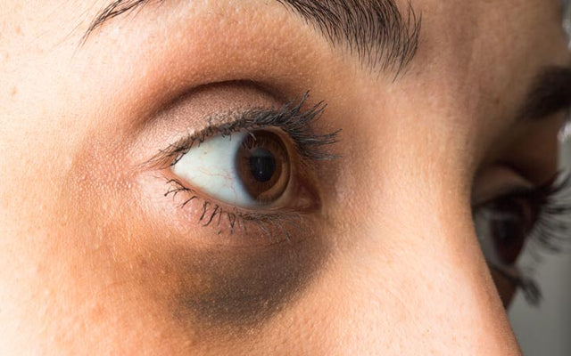 Donkere kringen onder uw ogen: oorzaken, behandelingen & preventietips