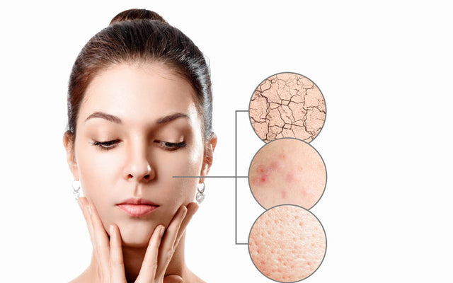 Droge huid en acne: behandel je het op de juiste manier?