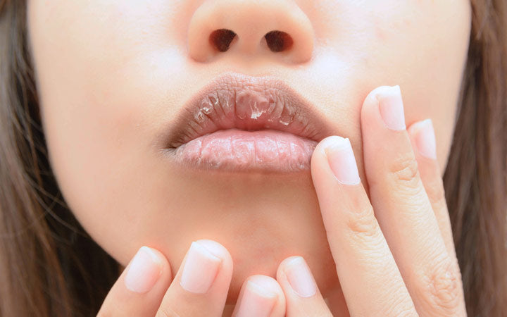 Hoe te kalmeren chapped &droge lippen: 5 oorzaken, 5 remedies &veelgestelde vragen