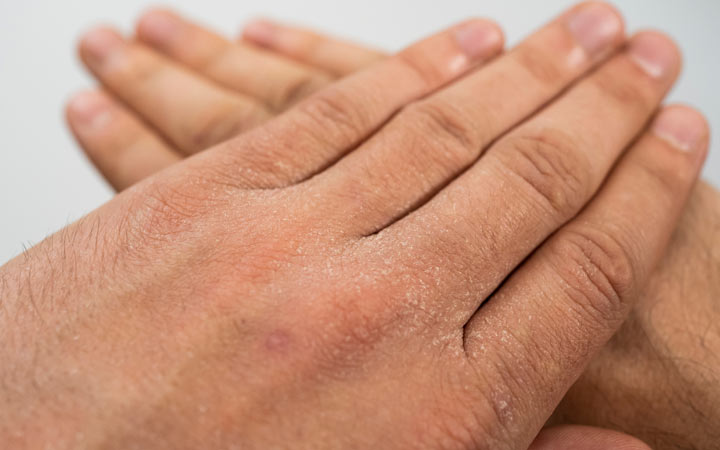 Wat is exfoliatieve dermatitis &hoe ziet het eruit? + Oorzaken en manieren om te behandelen