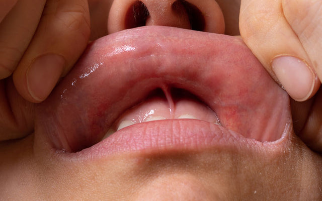 Fordyce Spots (White Bumps) Op de lippen: Symptomen, Oorzaken, Behandelingen &Risicofactoren