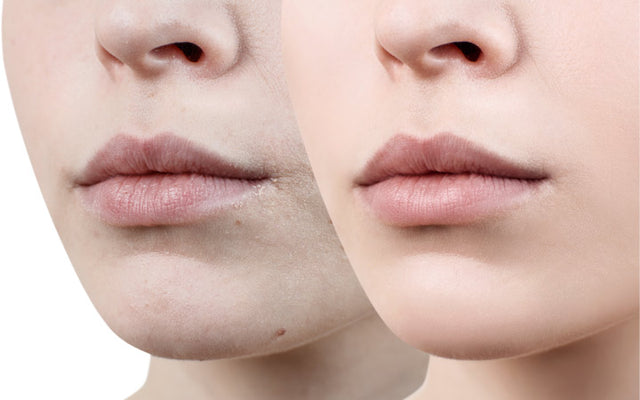 Hoe kun je een droge huid rond je mond behandelen?