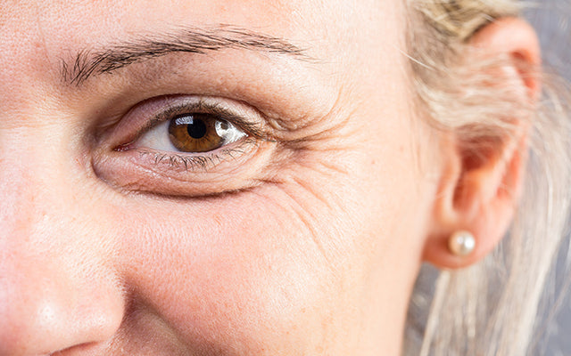 Kraaienpootjes rond de ogen: oorzaken, behandeling en preventie