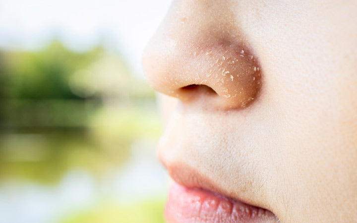 9 redenen van droge huid rond neus &hoe het te behandelen?