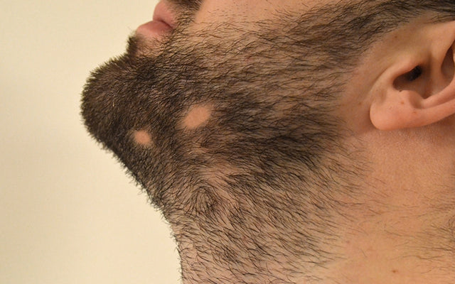 Veroorzaakt Alopecia Barbae kale plekken op je baard?