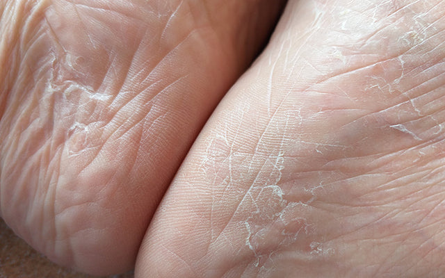 Wat is ashy huid - Symptomen, oorzaken &6 manieren om het te behandelen