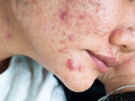 Wat is cystische acne en hoe behandel je het?