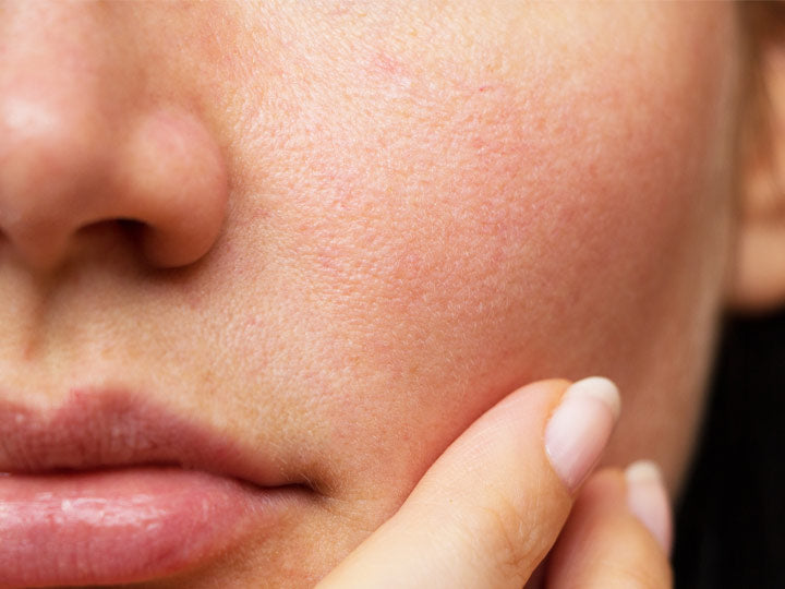 Hoe open poriën op het gezicht te sluiten - soorten, oorzaken, behandelingsmethoden