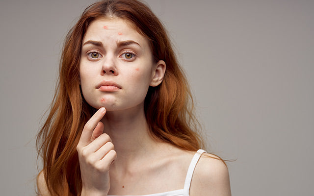 Veroorzaakt pindakaas acne? + Alternatieven &manieren om het te behandelen