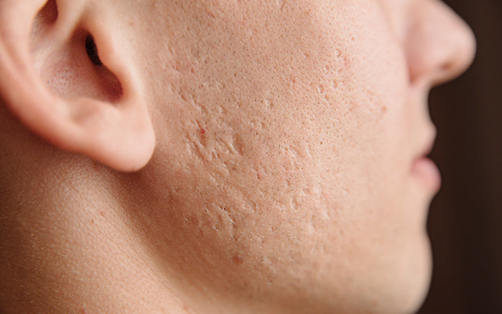 Hoe zich te ontdoen van acne littekens + Hoe lang duurt het om te vervagen