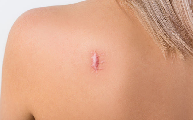 13 manieren om uw keloïde littekens te behandelen