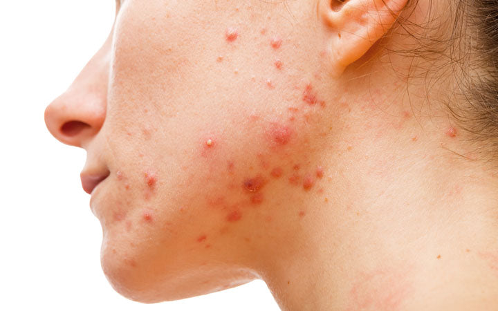 Vrouwen met cystische acne