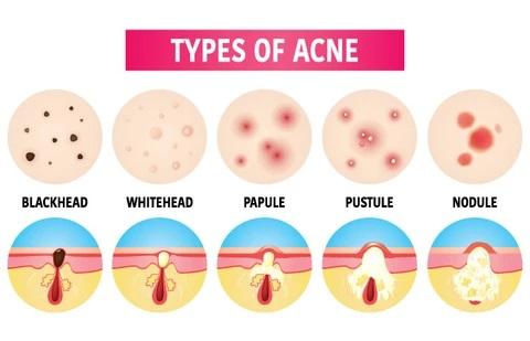 Soorten acne