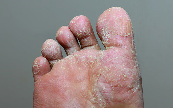 voetschimmel met schimmelinfectie