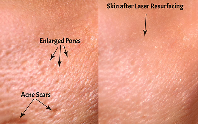 Vergelijking van de huid voor en na laser resurfacing