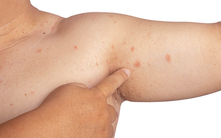 allergische huiduitslag dermatitis eczeem huid van de oksel van de patiënt