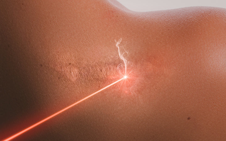 vrouwelijke schouder en laserstraal tijdens littekenverwijderingsbehandeling