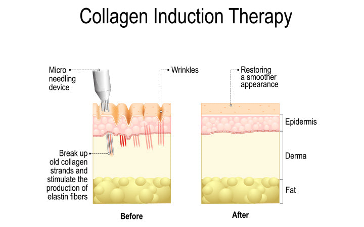 Voor en na resultaten van collageeninductietherapie
