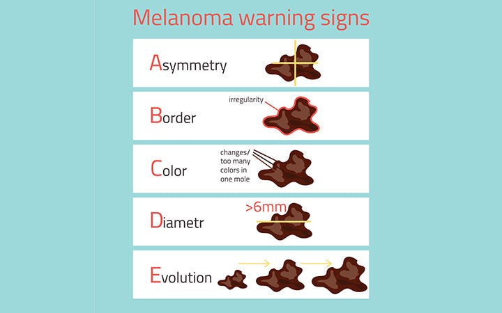 melanoom-waarschuwingssignalen