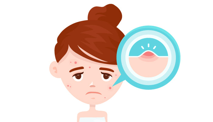 Acne: Oorzaken, Symptomen, Behandelingen & Preventie Tips