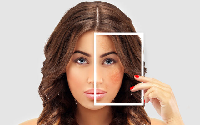 Hoe zich te ontdoen van hyperpigmentatie acne
