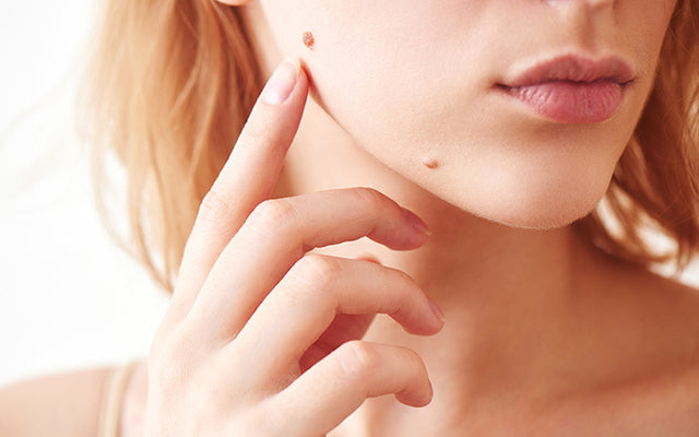 Hoe zich te ontdoen van moedervlekken van uw huid?