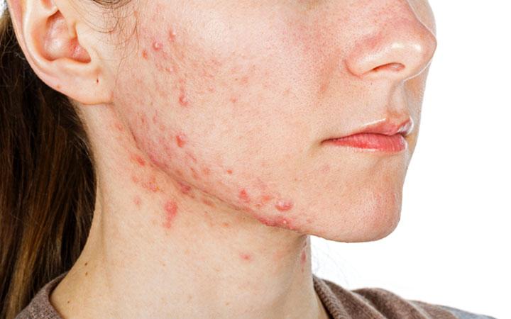 Hoe nodulaire acne te identificeren en te behandelen?
