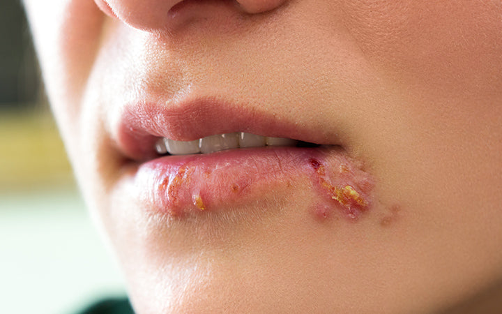 meisjes lippen vertonen herpes