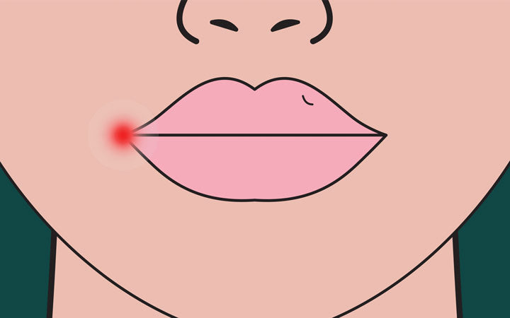 herpes op lip rode ontsteking op lip van vrouw