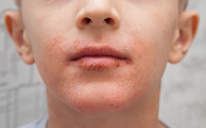 atopische huid op het gezicht van de jongen allergische uitslag op gezicht en lippen