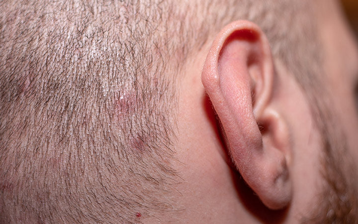zijaanzicht met oor in shot van een man met kort haar die lijdt aan hoofdhuidacne