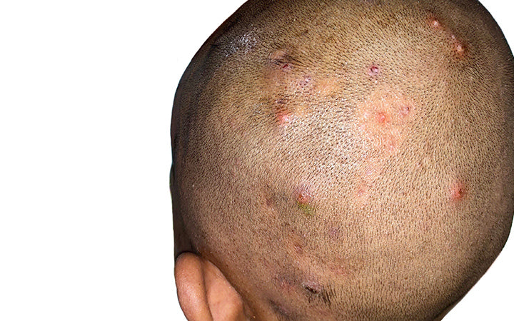 Talrijke pijnlijke furuncles of steenpuisten en folliculitis op het hoofd.