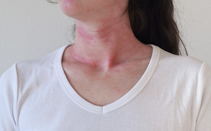 allergische huidreactie op vrouwelijke nek
