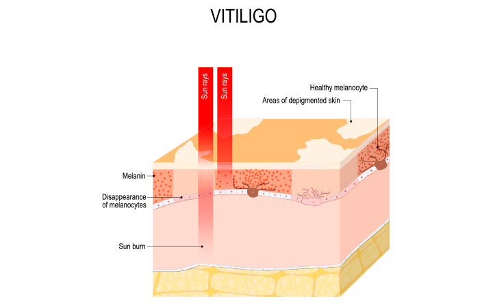 Een huidaandoening Vitiligo