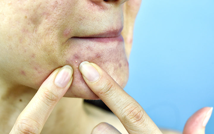 Close-up foto van acne gevoelig huidprobleem