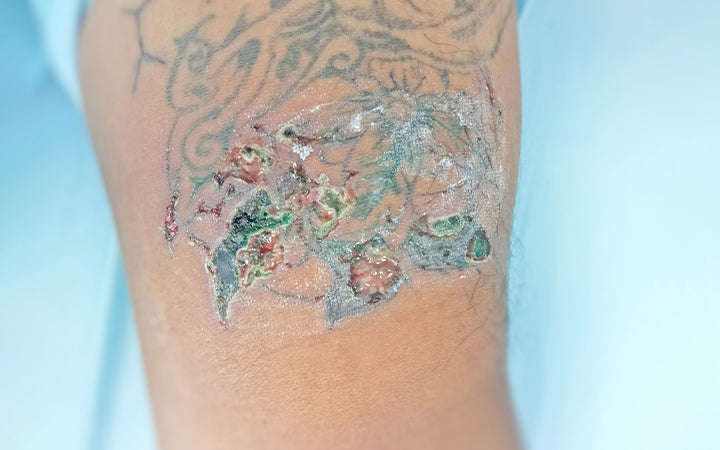 Tattoo infectie