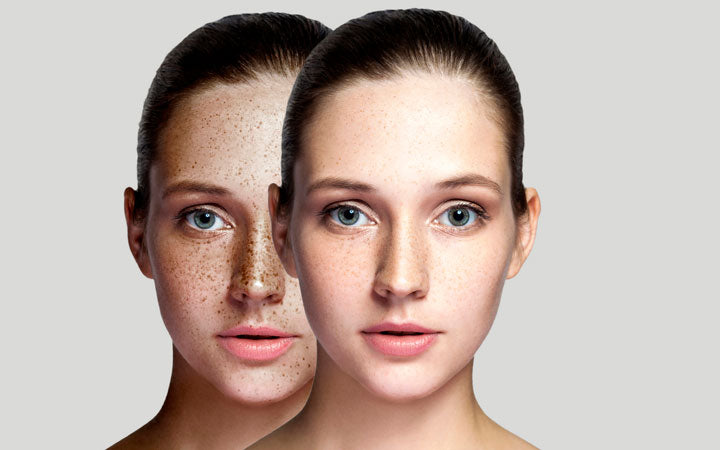 voor en na het gezicht van de vrouw die sproeten op het gezicht verwijdert